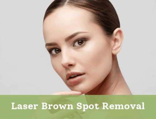Laser Brown Spot Removal