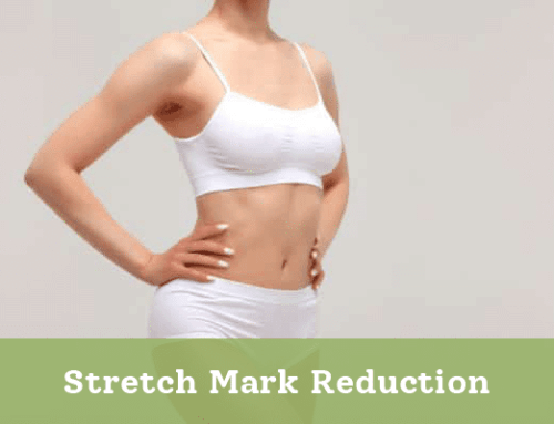 Stretch Mark Reduction