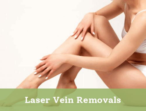 Laser Vein Removals