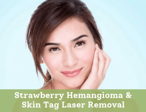 Strawberry Hemangioma & Skin Tag Laser Removal