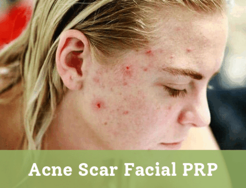 Acne Scar Facial PRP