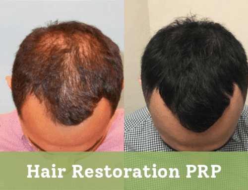 Hair Restoration PRP