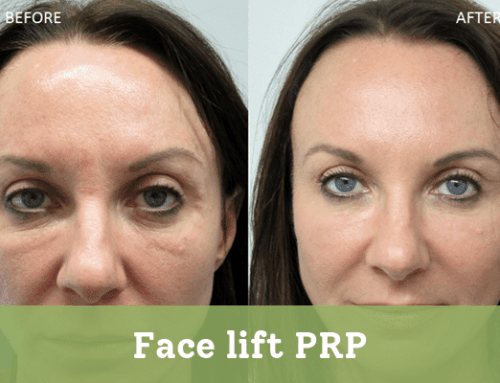 Face lift PRP