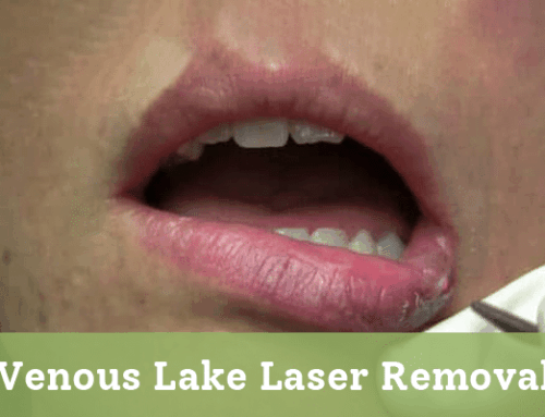 Venous Lake Laser Removal