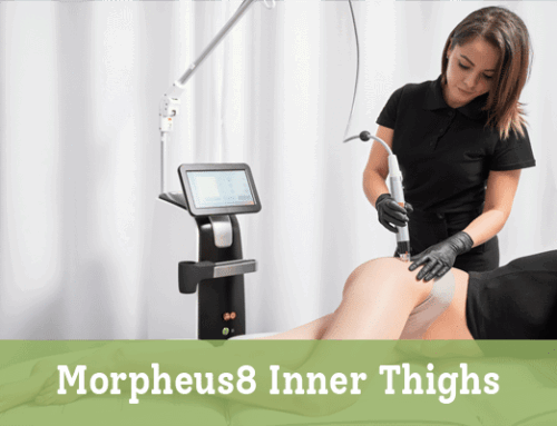 Morpheus8 Inner Thighs