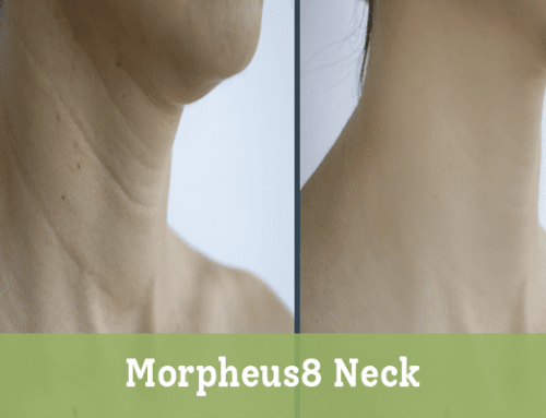 Morpheus8 Neck