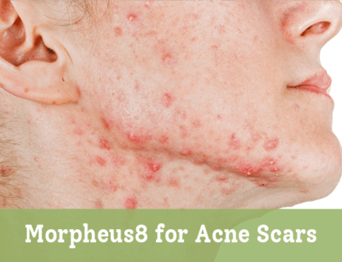 Morpheus8 for Acne Scars