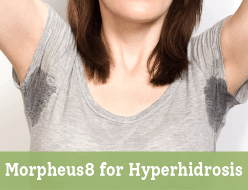 Morpheus8 for Hyperhidrosis